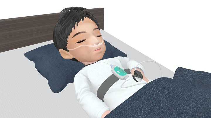 Sleep Apnea Syndrome Screening – Kostenloses 3D-Modell STL