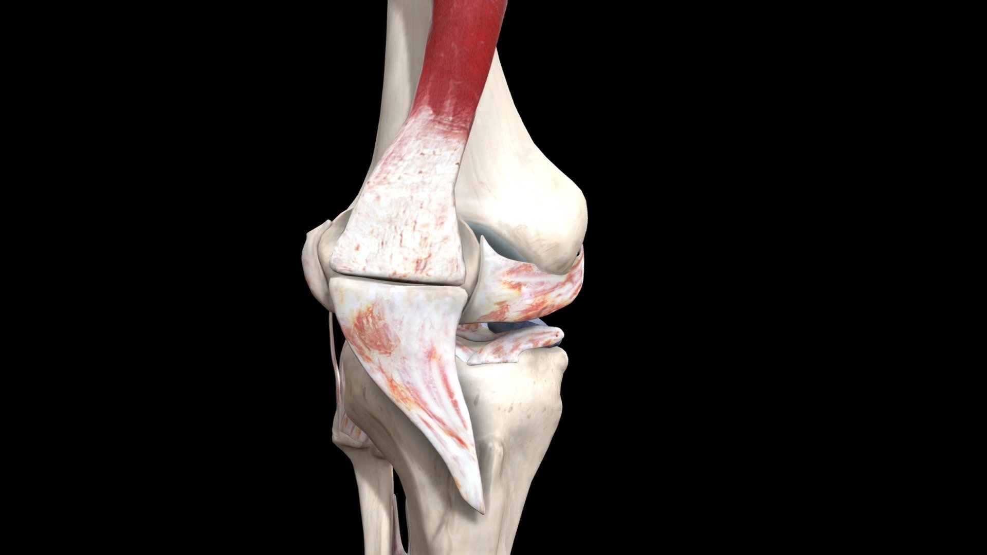 Patella Sublaxated - 3D model by Znyth Technologies (@znyth) [5796f9a ...