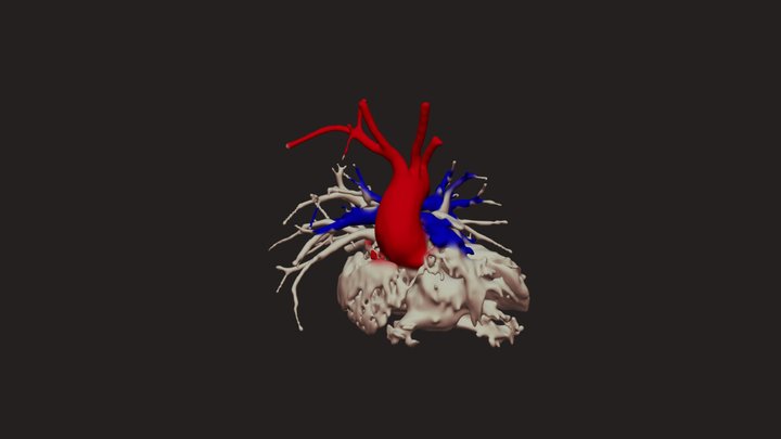 Tetralogy of Fallot – Free 3D Model STL