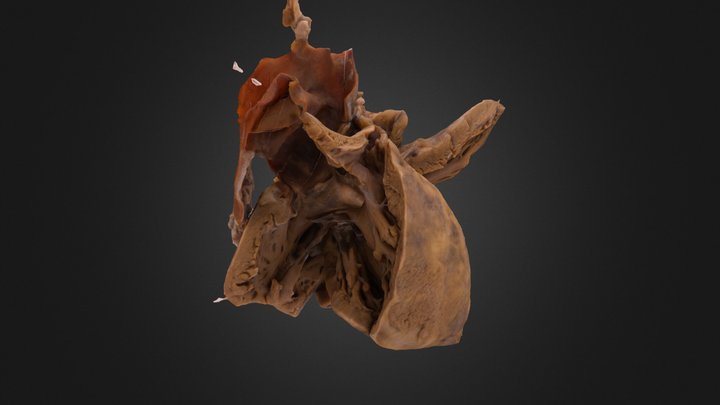 Outlet perimembranous VSD 3D Model
