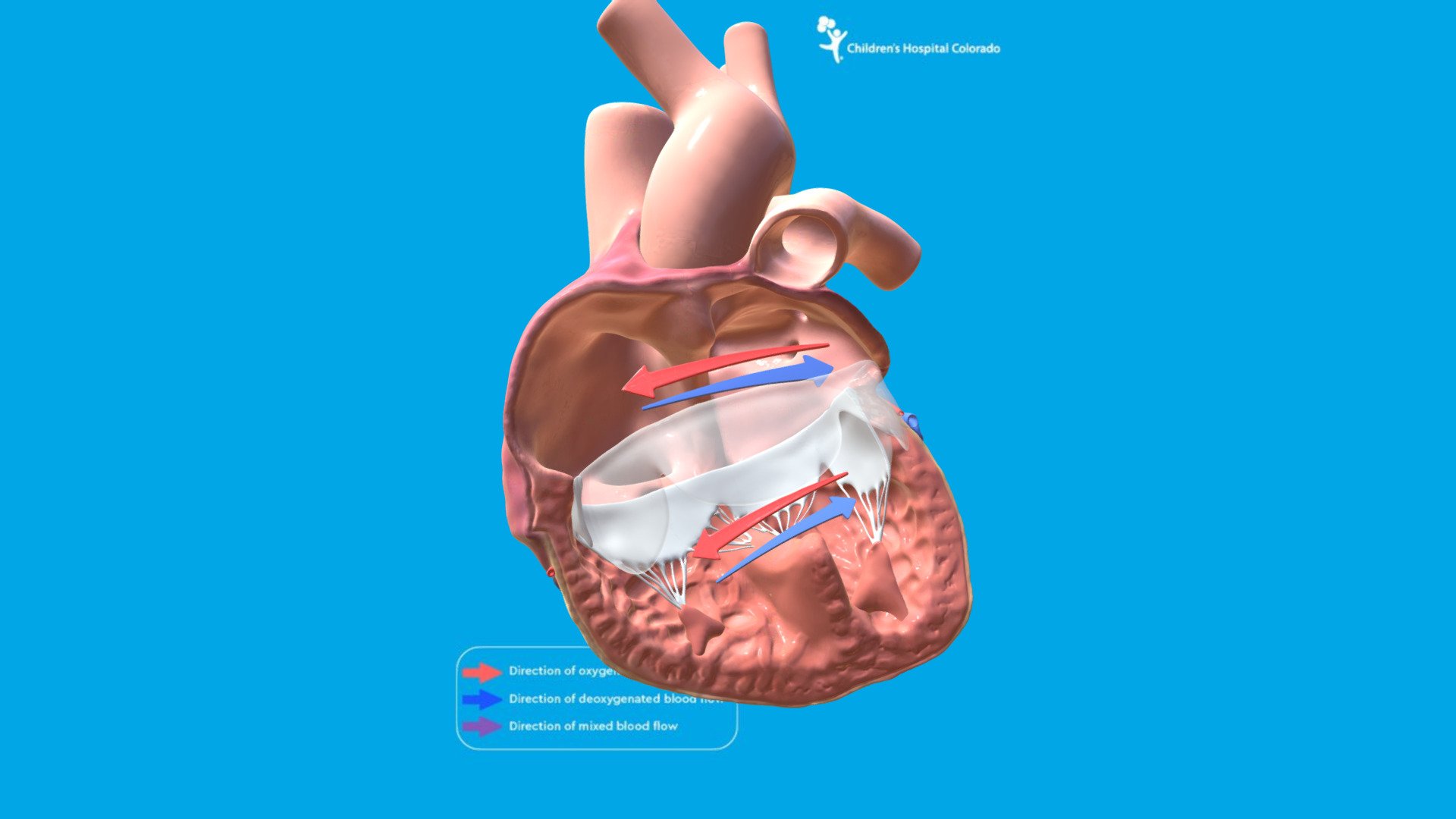 Atrioventricular Canal Defect - 3D model by Children's Hospital Colorado  Medical Media (@CHCOMedicalMedia) [581deed]
