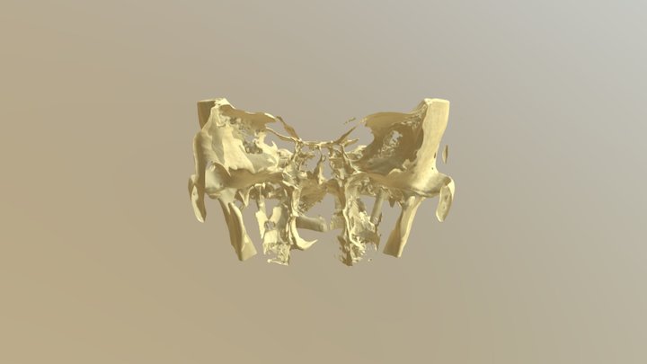 OSTEOARTROSIS 3D Model