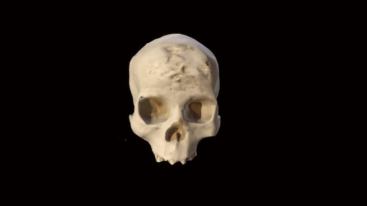 Venereal Syphilis 3D Model