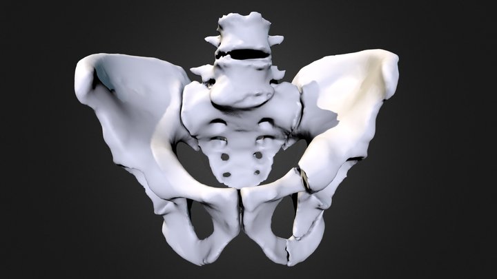 pubic bone and intestinal fracture | M-1507325 3D Model