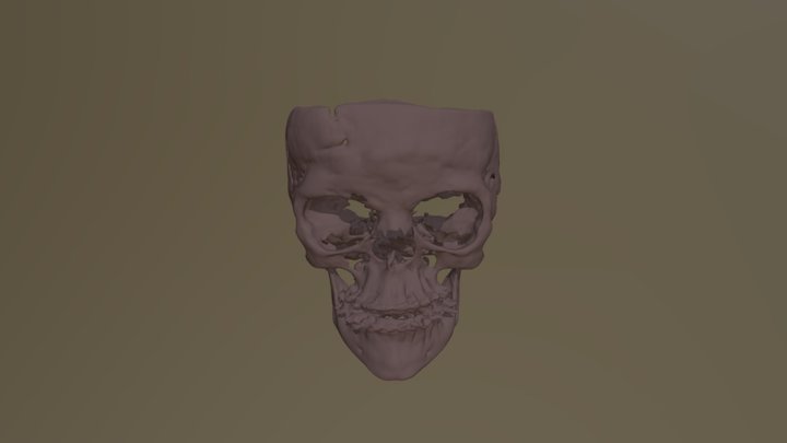 SINDROME DE APERT 3D Model