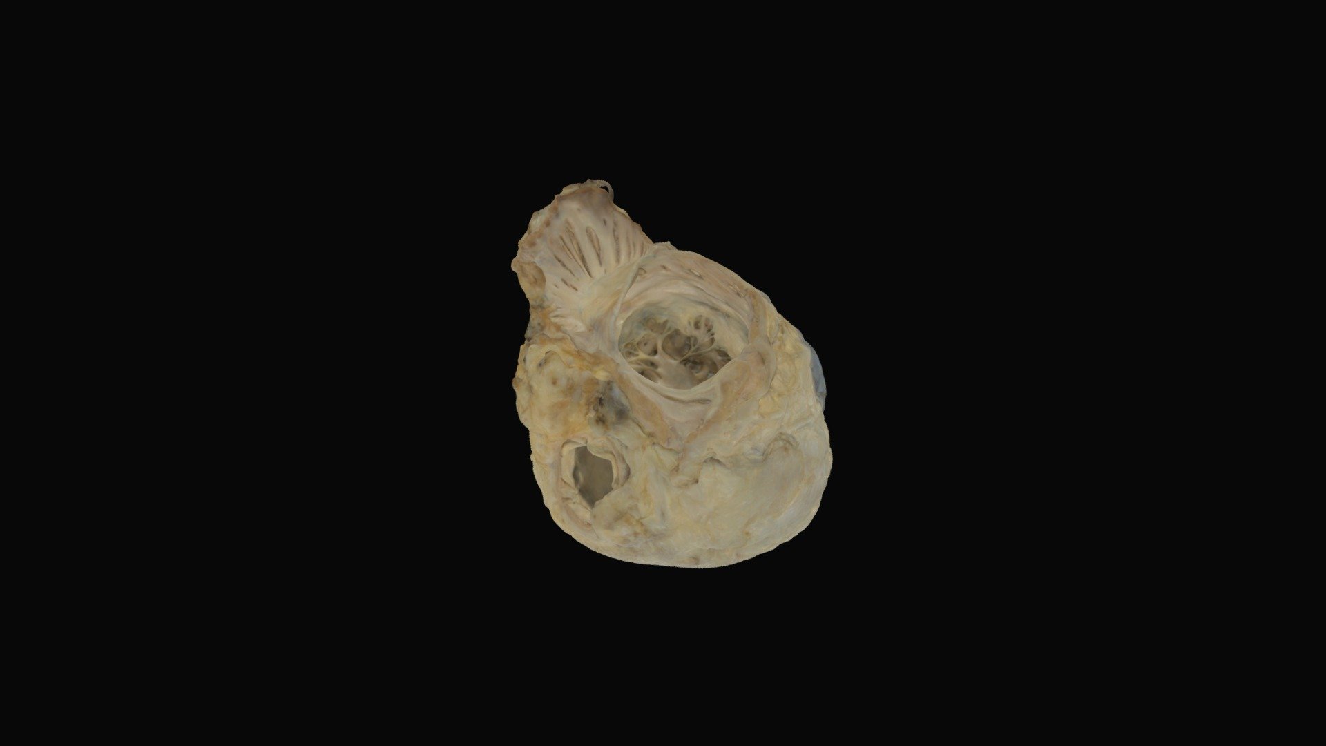 Heart with Hypoplastic Left Heart Syndrome