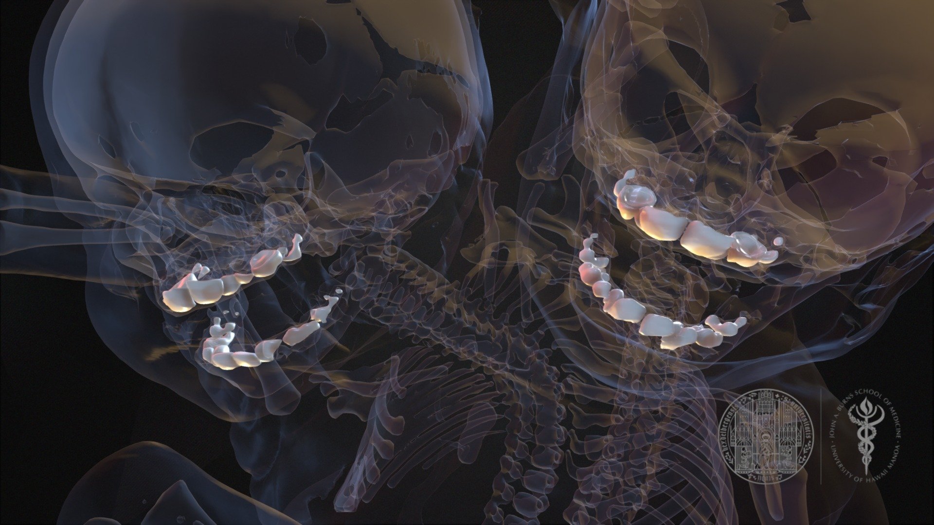 Conjoined Twins Teeth 3D model by John A Burns School of Medicine