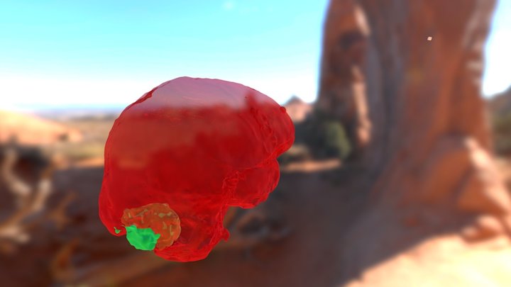 Brain With Calcification 3D Model