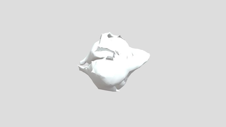 Tumor 3D Model