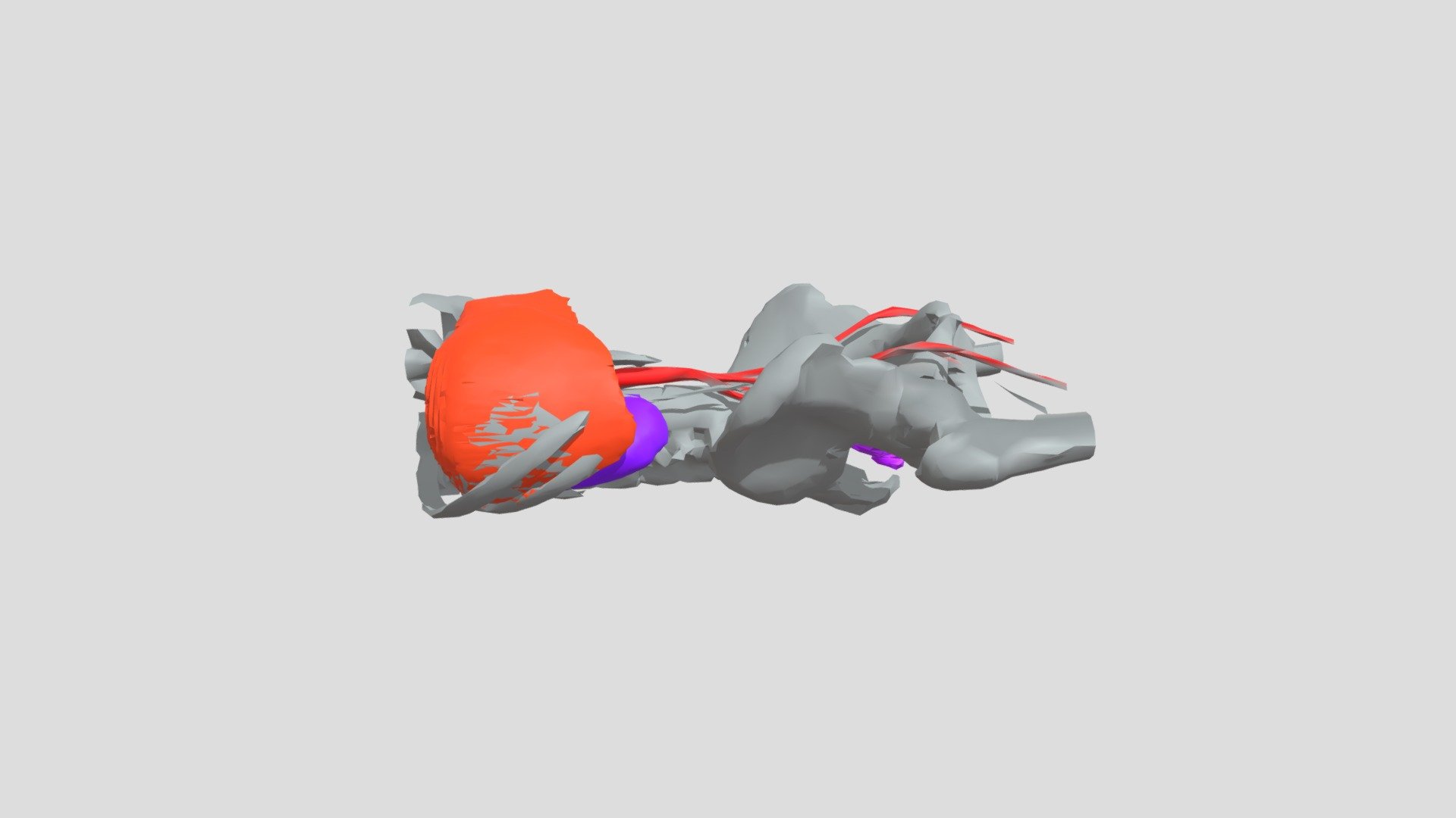 3D Tumor Liver Kidney vessels_Miyoshi