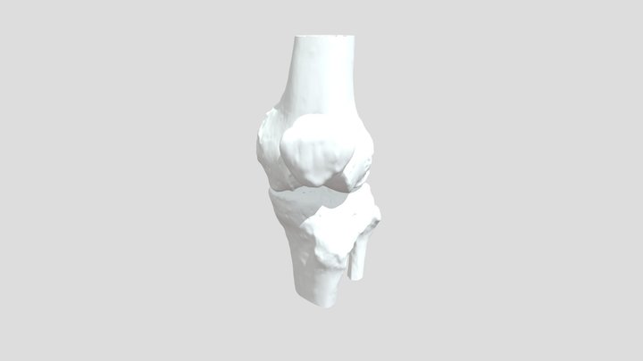 膝关节退行性变 3D Model