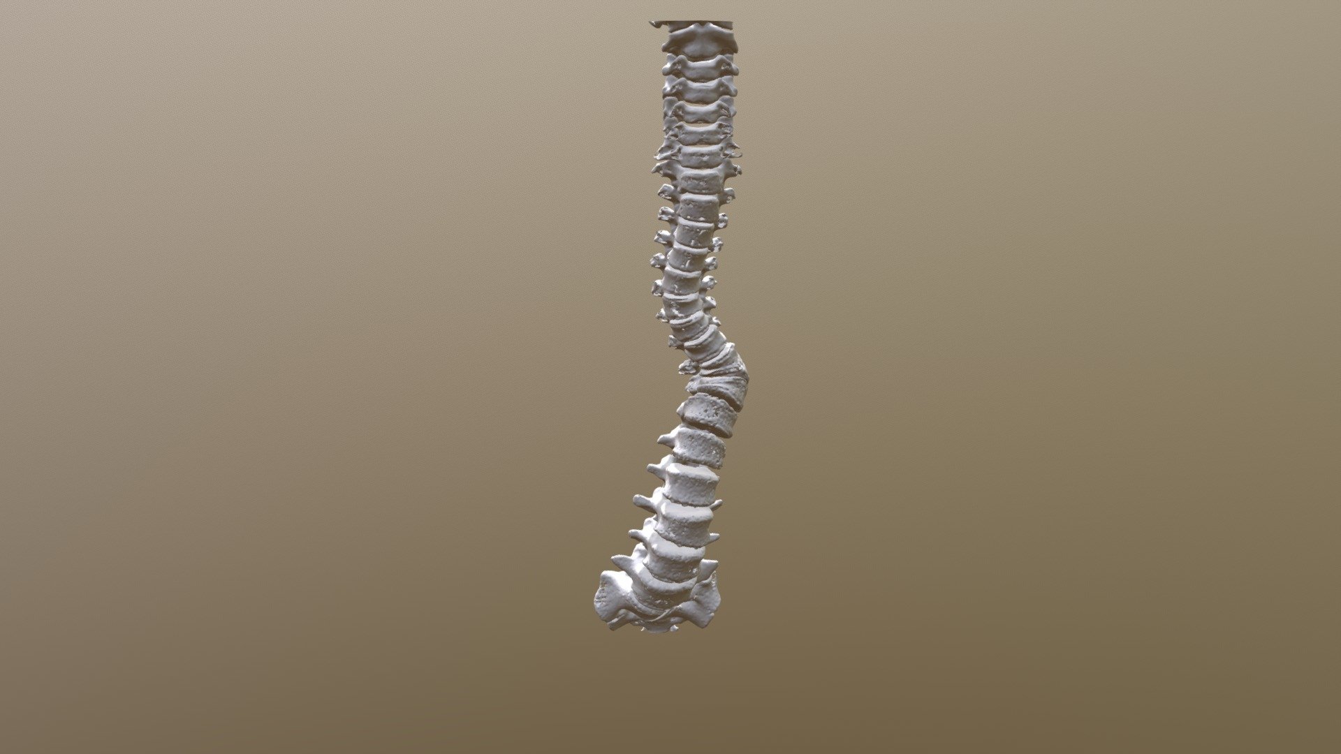 脊椎側彎 - 3D model by FablabNDMC [5ae68bf] - Sketchfab