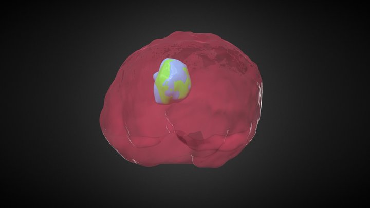 Tumor Segmentation (Like, For Real This Time) 3D Model