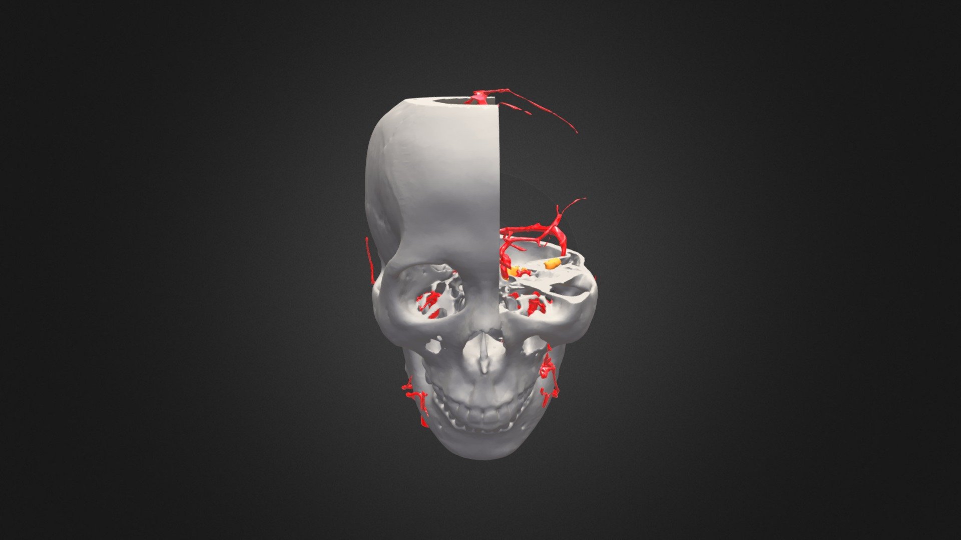 petrosal tumour 2