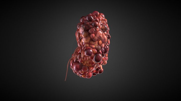 Polycystic Kidney 3D Model