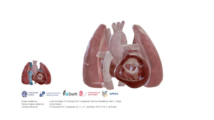 Heart after Fontan Procedure – Modello 3D gratuito STL