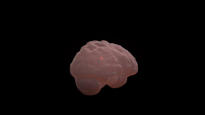 Brain Lesion 3D Model