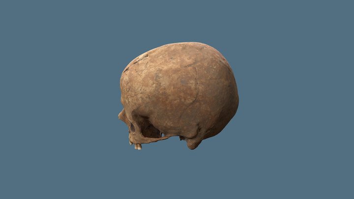 SRP6775 Cranium Superficial Trauma 3D Model