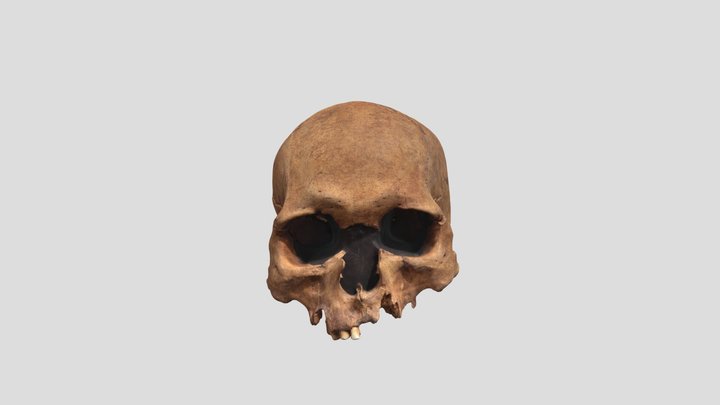002 Trepanned Skull (compressed) 3D Model