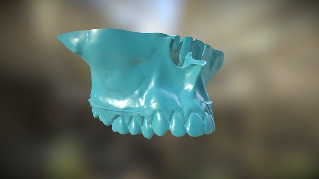 Maxillary Constriction | BioModel 3D Model
