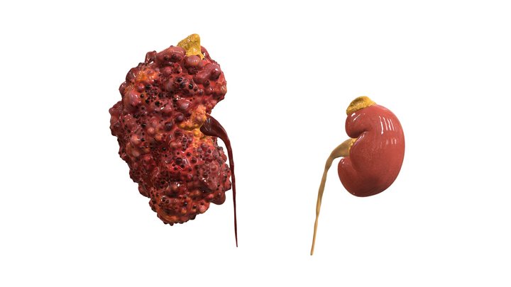 Polycystic Kidney vs Healthy Kidney 3D Model