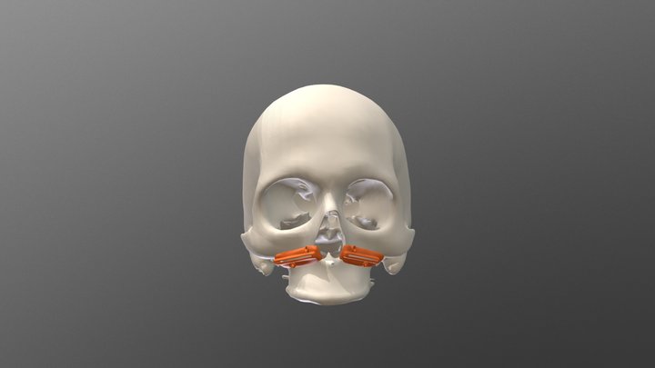 Guia de Osteotomia 3D Model