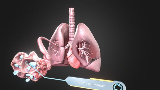 Edema Pulmonar Baked 3D Model