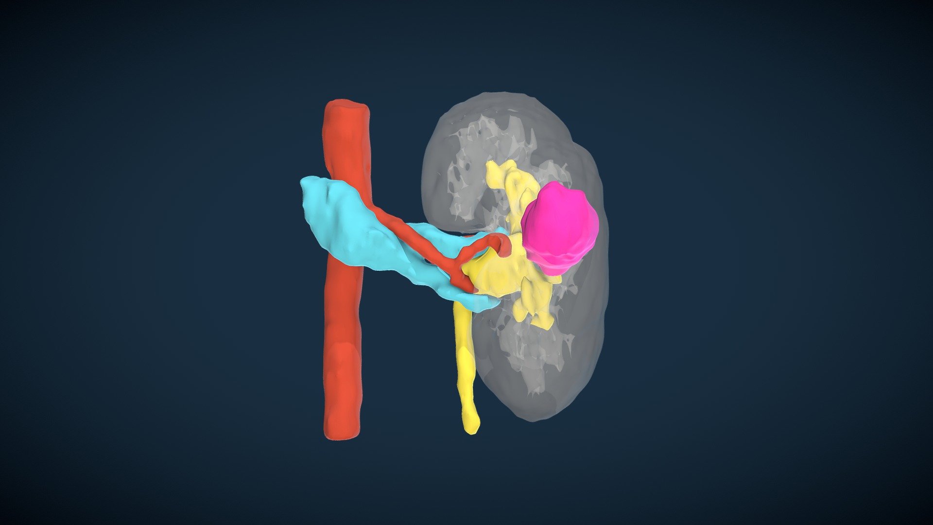 Left Kidney with tumor and cyst (A.R.T.C.)