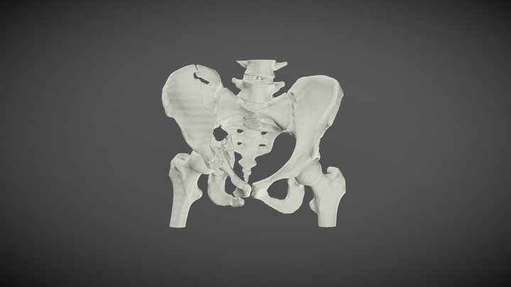 Pelvic Fracture 3D Model