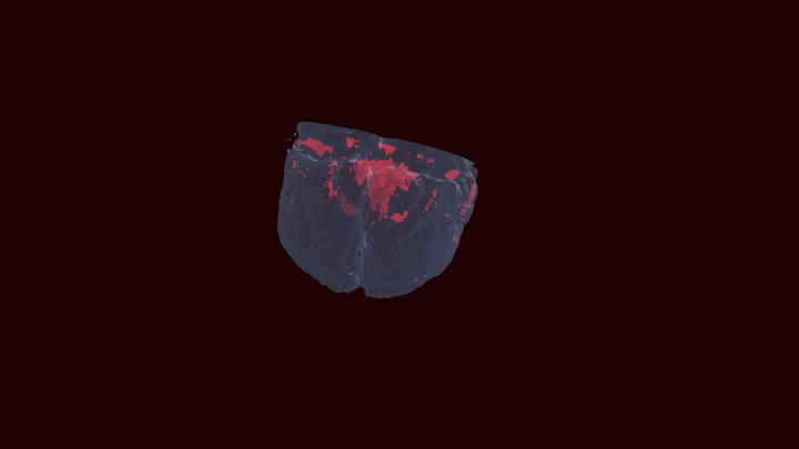 SplitBrain_model_during_a_task_ADHD_patient 3D Model