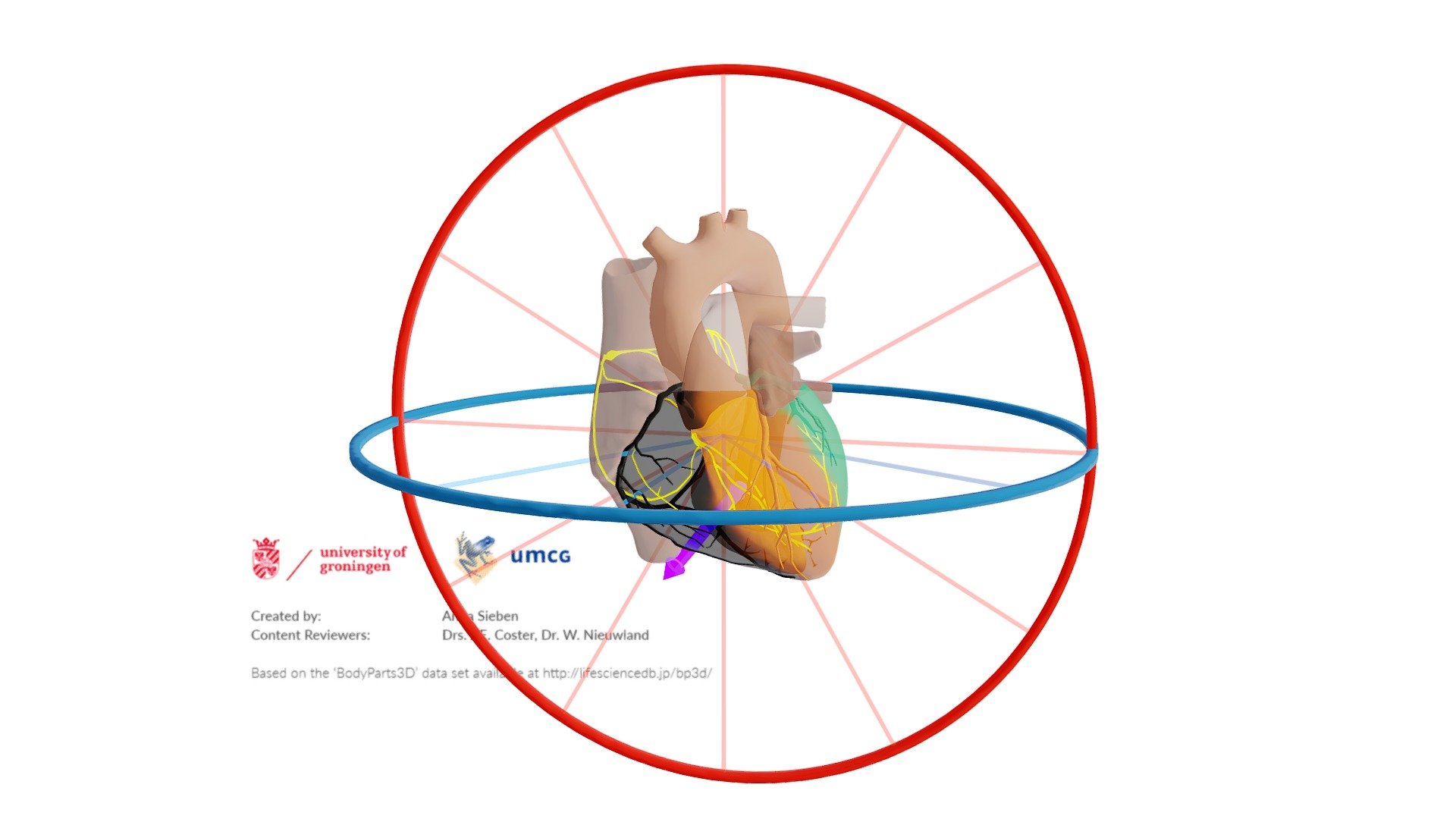 RCA Infarct met Afleidingen en Vector