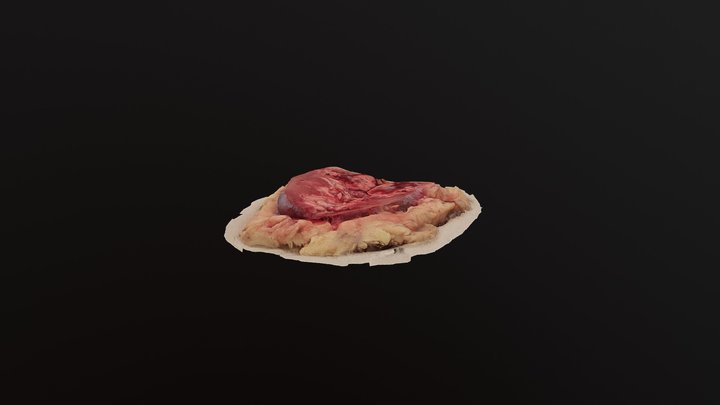 Kidney Tumor 1 3D Model