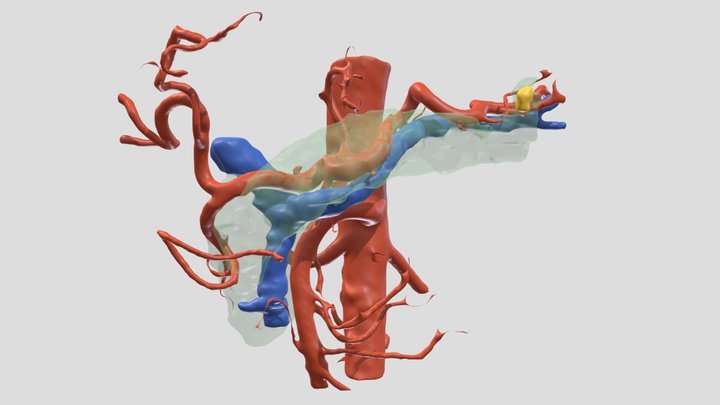 Páncreas - Tumor Neuroendocrino en cola 3D Model