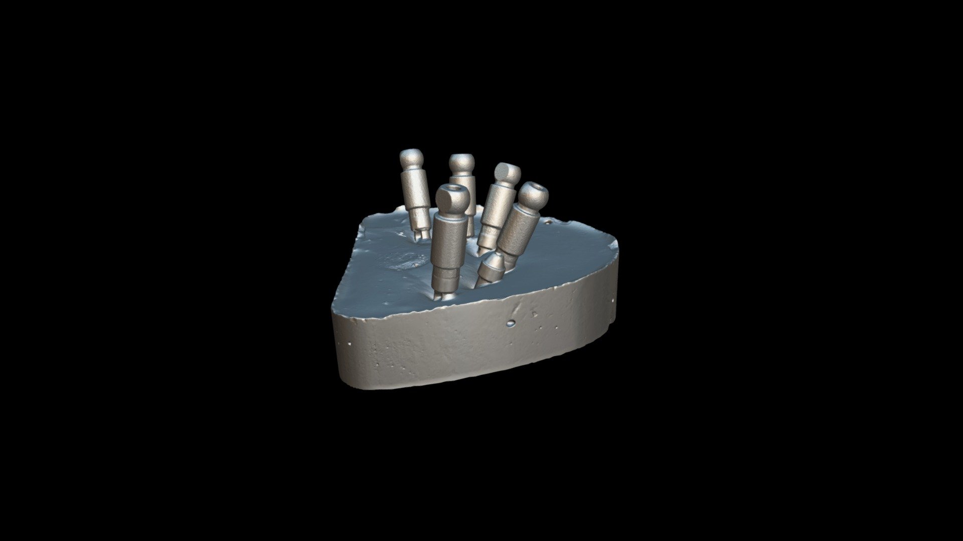 Implant-denture