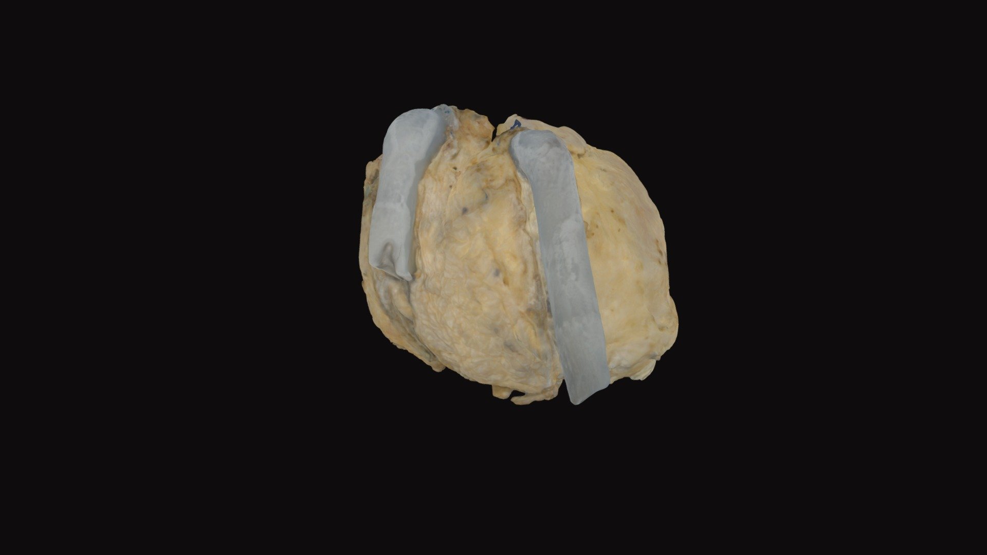 Pediatric Transplant Heart with Double VAD