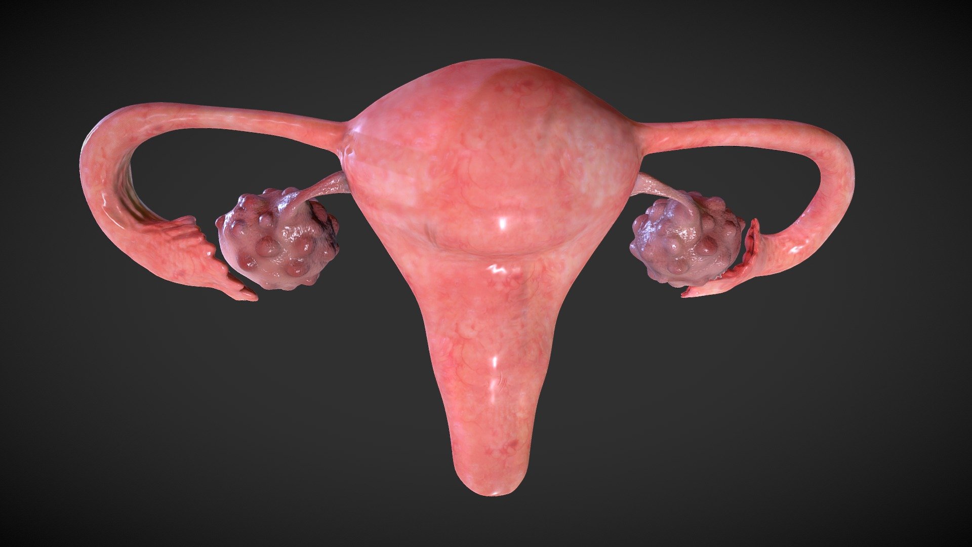 Polycystic ovary syndrome - 3D model by Ebers (@Ebers) [62bfb49]
