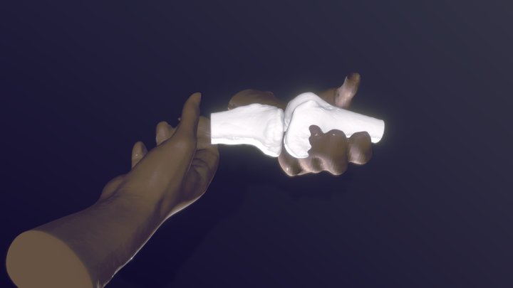 Lachman Test ACL Deficiency 3D Model