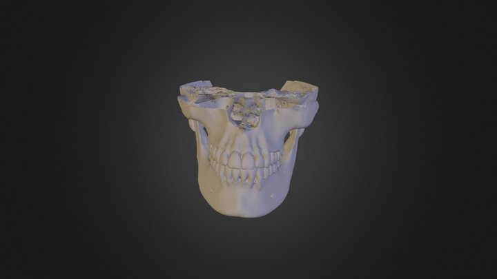 Dental Fracture LQ 3D Model