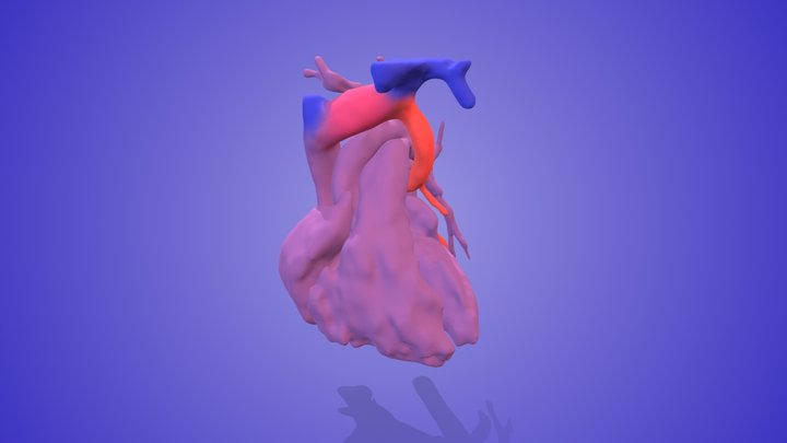 TAPVR (Supracardiac) – Free 3D Model STL