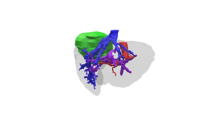 Hepatocellular carcinoma in VI-VII segments 3D Model