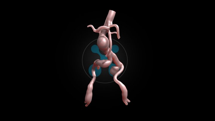 Infrarenal aortic aneurysm #008 3D Model