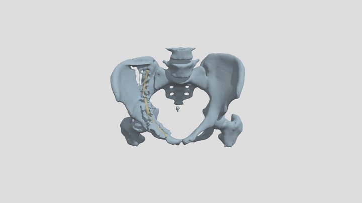 Fractured Pelvis Segmentation 3D Model