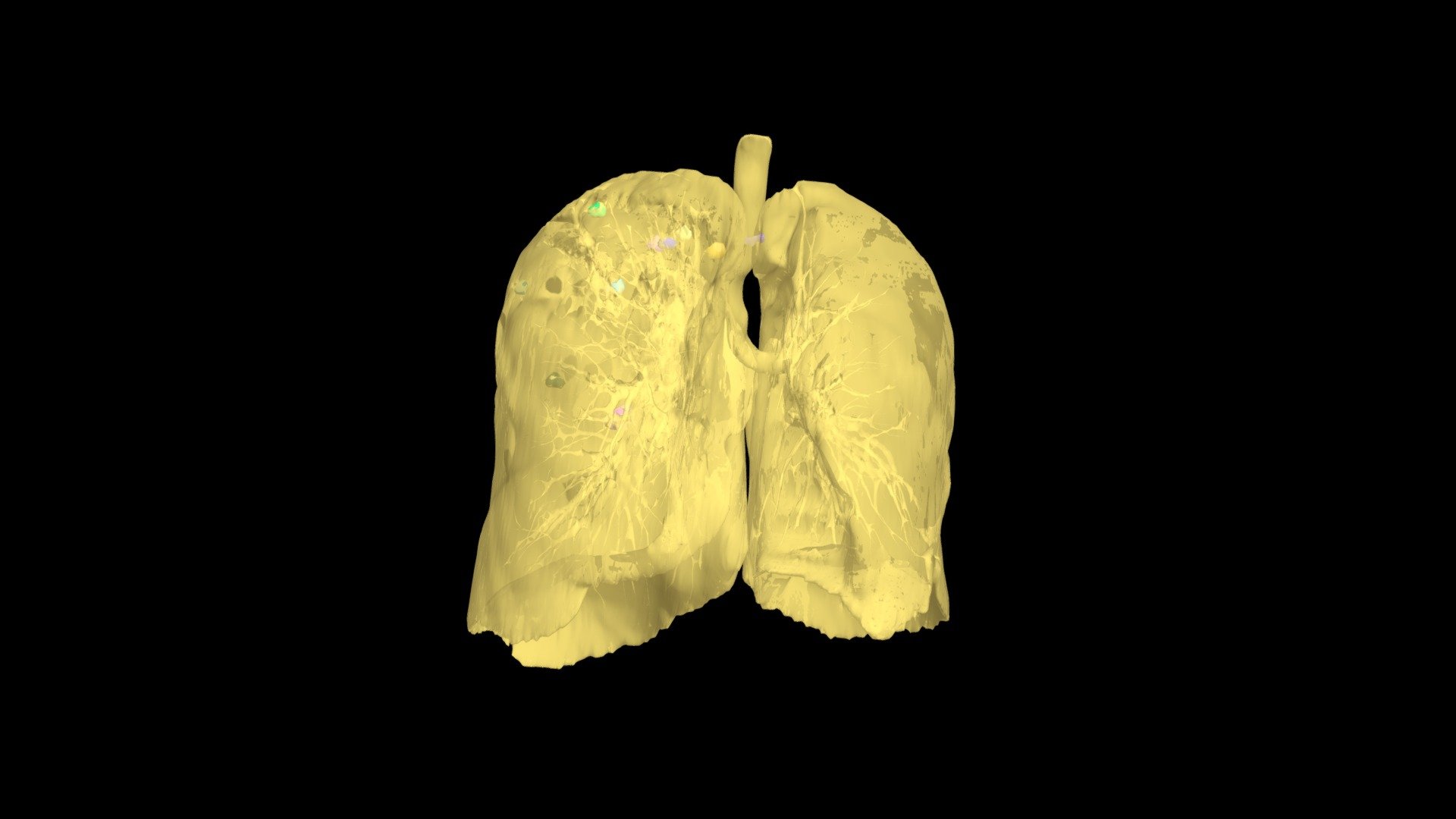 NSCLC Model 179