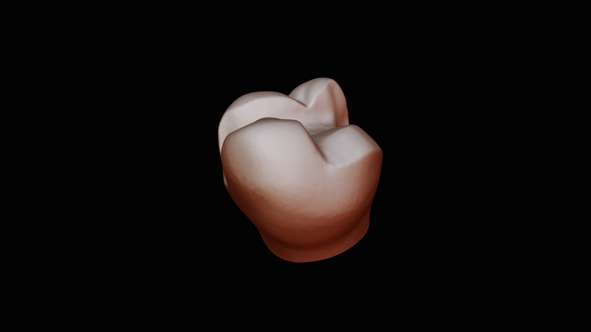 # 3 Ceramic Onlay Prep - 3D model by VCU - Restorative Dentistry ...