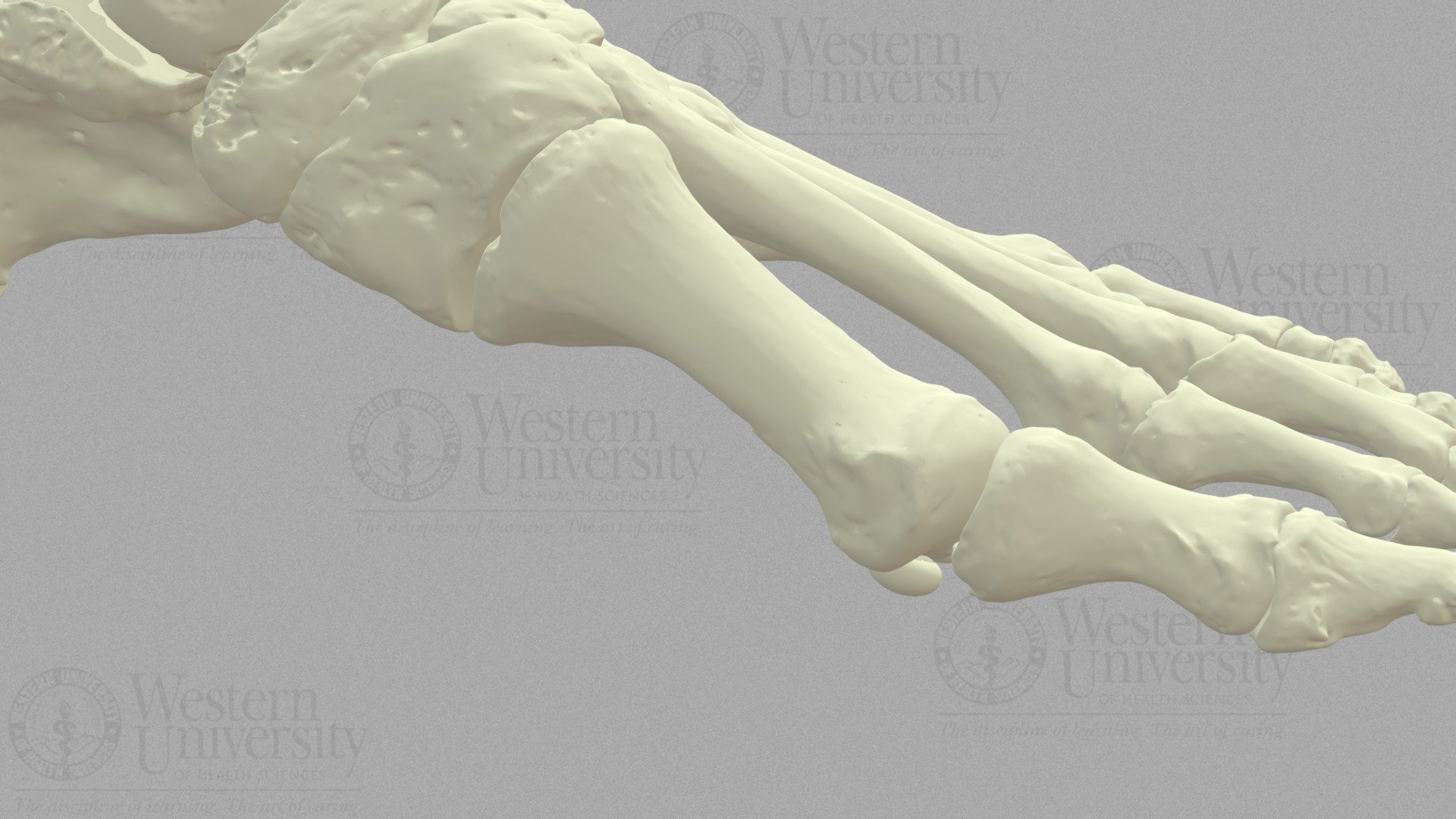 HAV Moderate Deformity - Austin Osteotomy - 3D model by WesternU3D ...