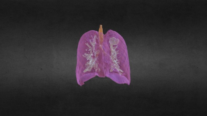 Lung Tumor 3D Model