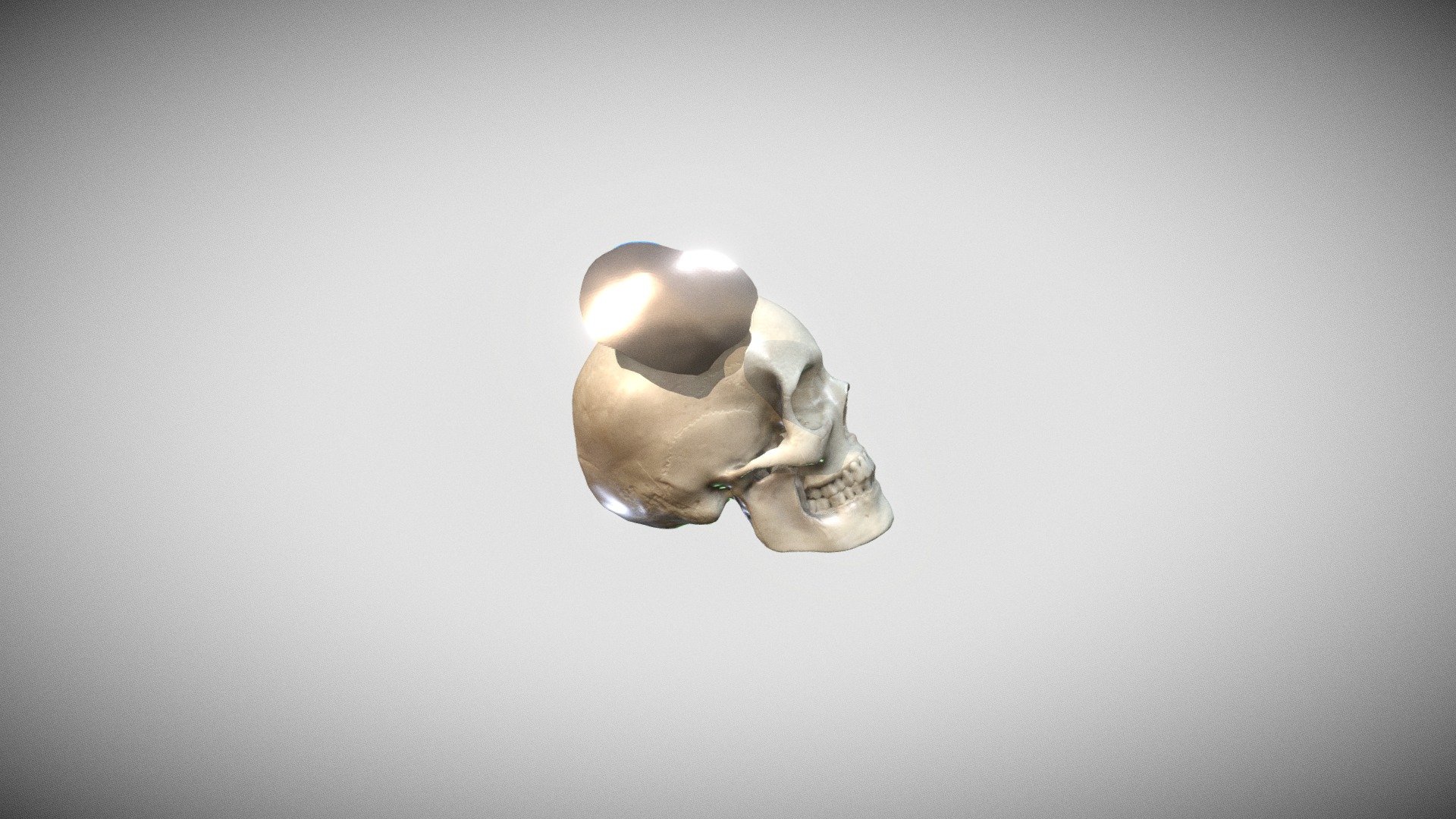 Cranioplasty