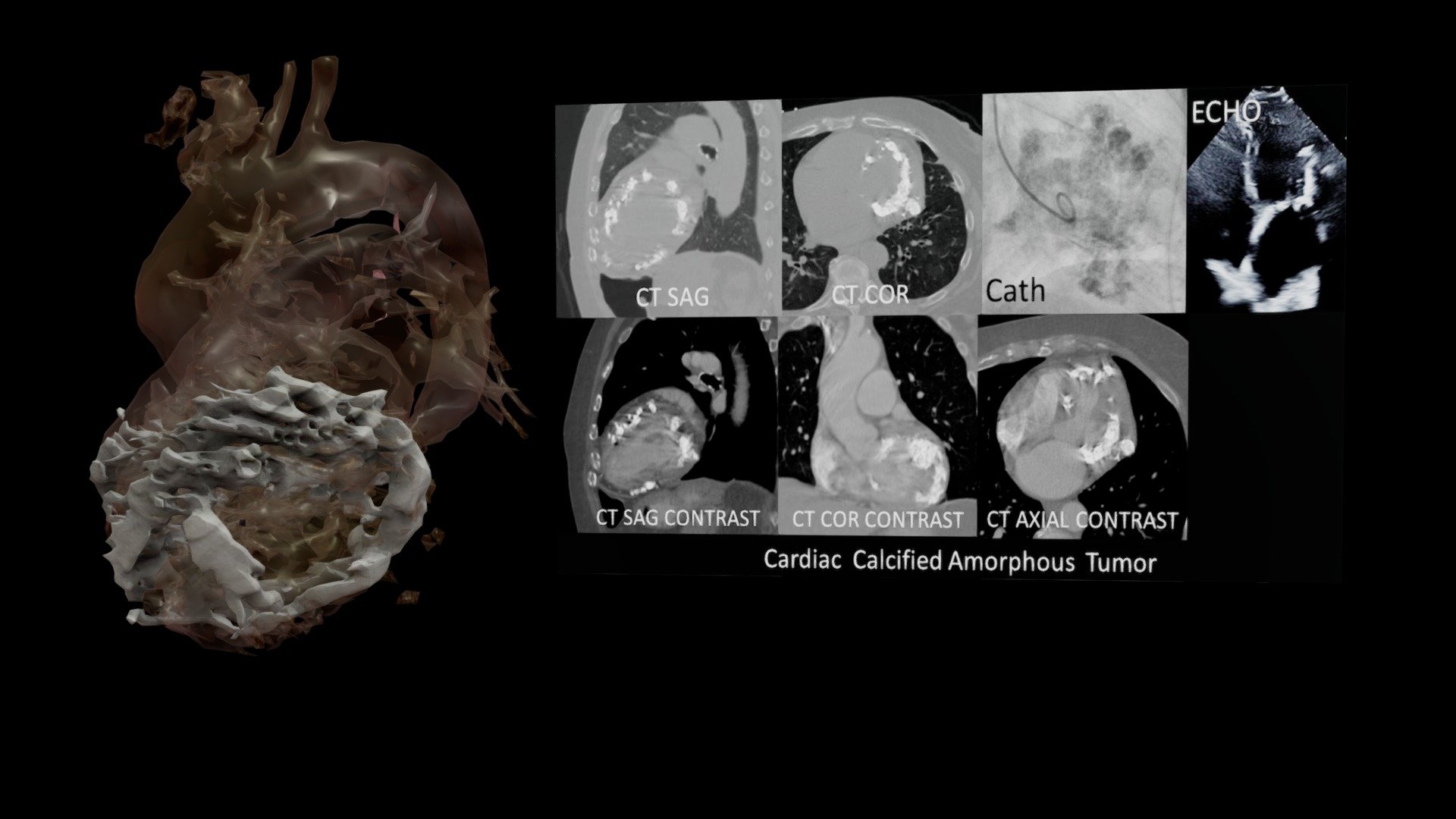 Cardiac Calcified Amorphous Tumor