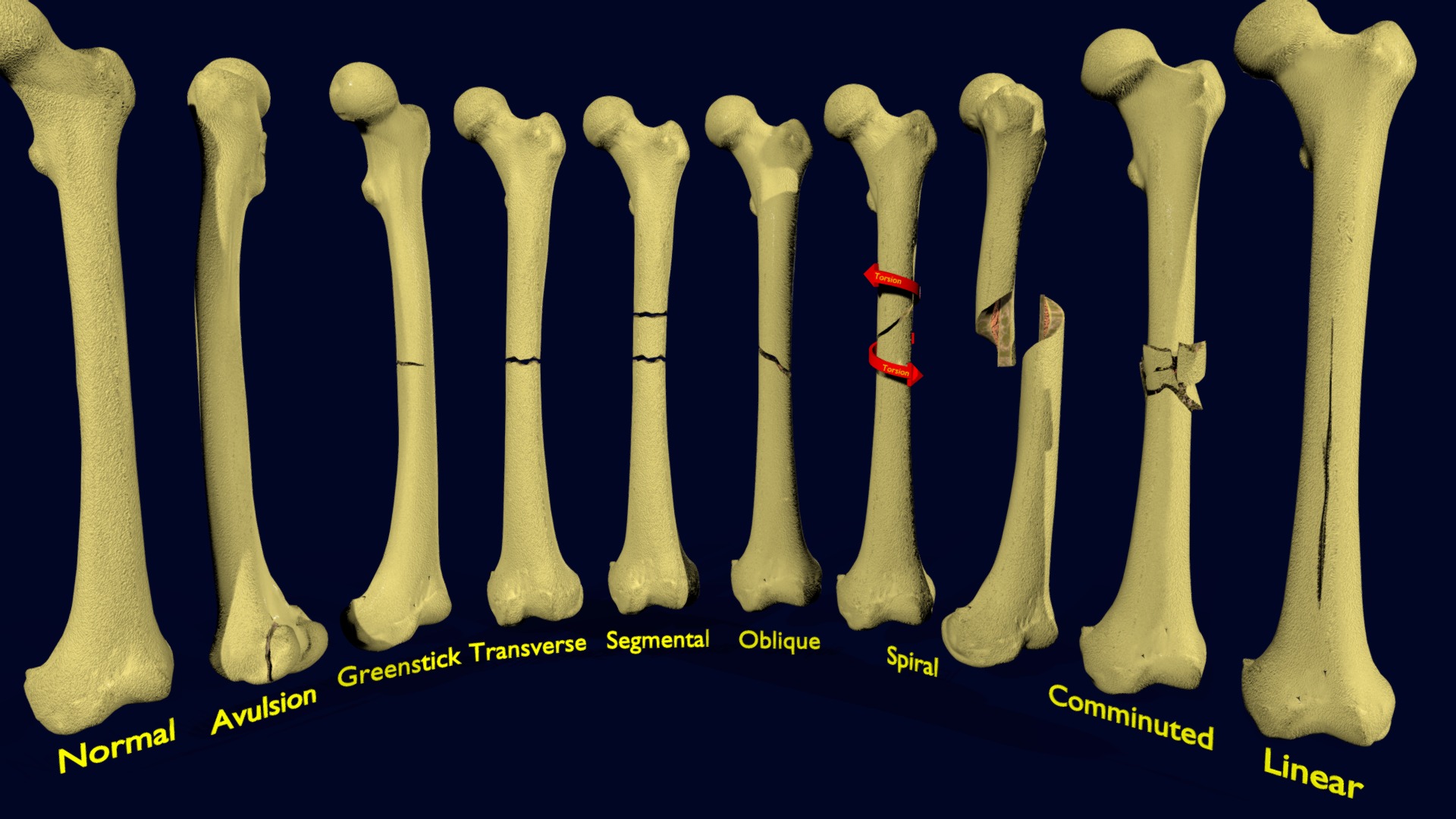 3D model Fracture types labelled - This is a 3D model of the Fracture types labelled. The 3D model is about a group of boneless teeth.