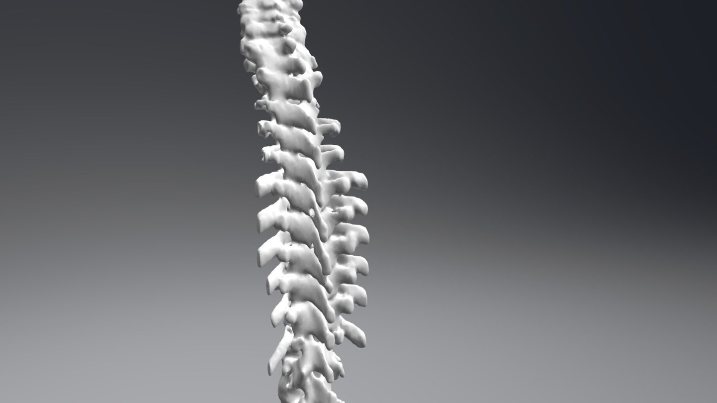 Full-sized patient-specific spine from CT
